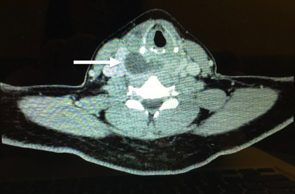 Retropharyngeal Abscess CT.001