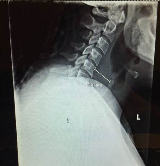 Retropharyngeal Abscess Xray.001